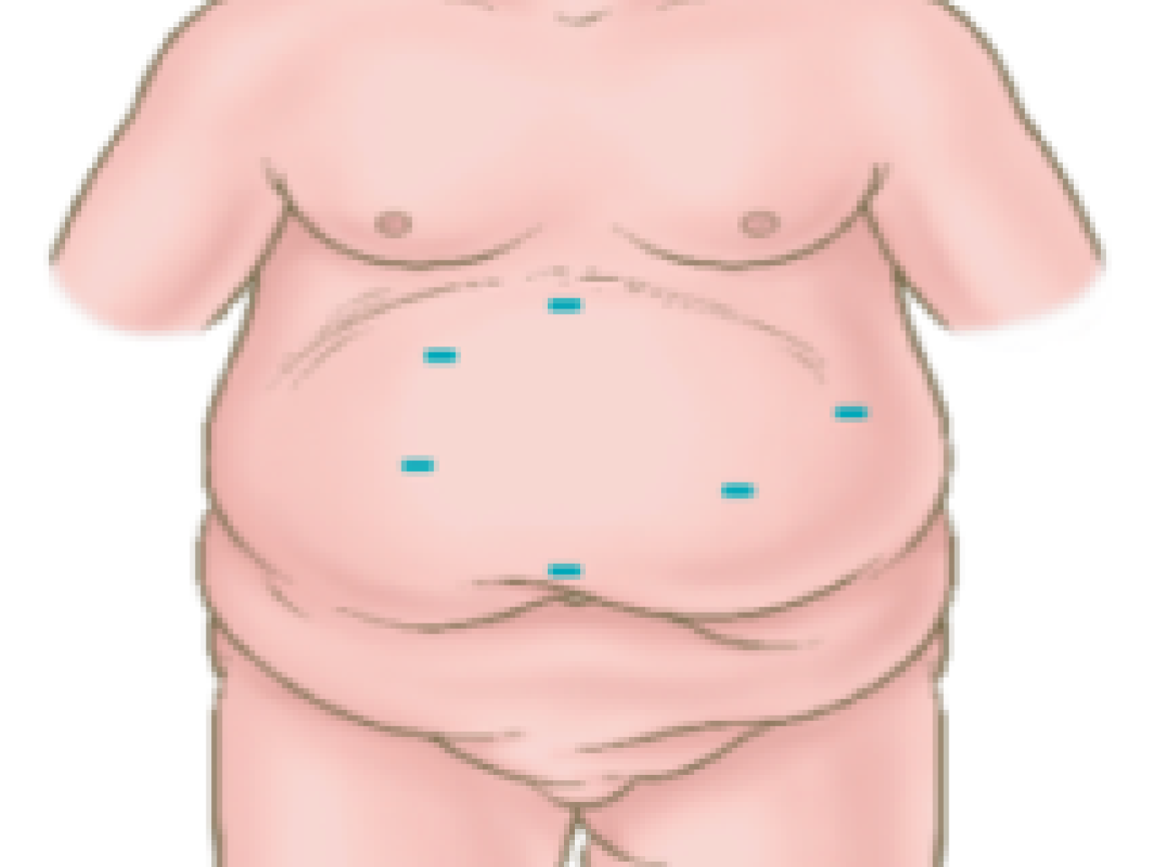 Bariatric Incisions.