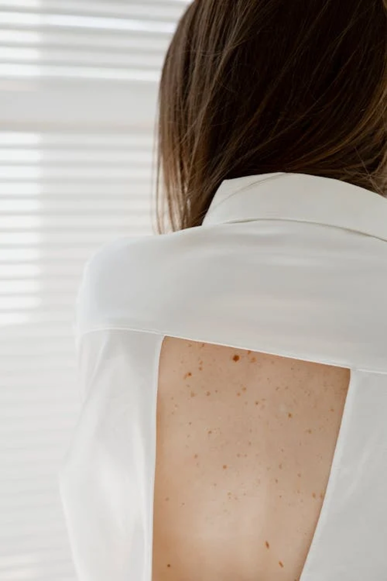 woman with moles and freckles on her back.